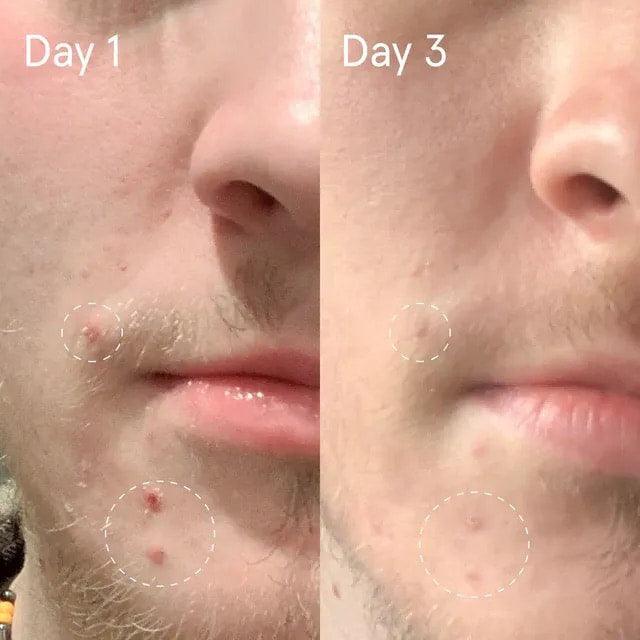 Sulfur Spot Treatment - HOUS OF ESTHETICS